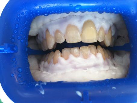 Le Docteur Smadja, dentiste Cannes digue liquide