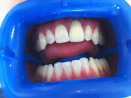 Le Docteur Smadja, dentiste Cannes step whitening