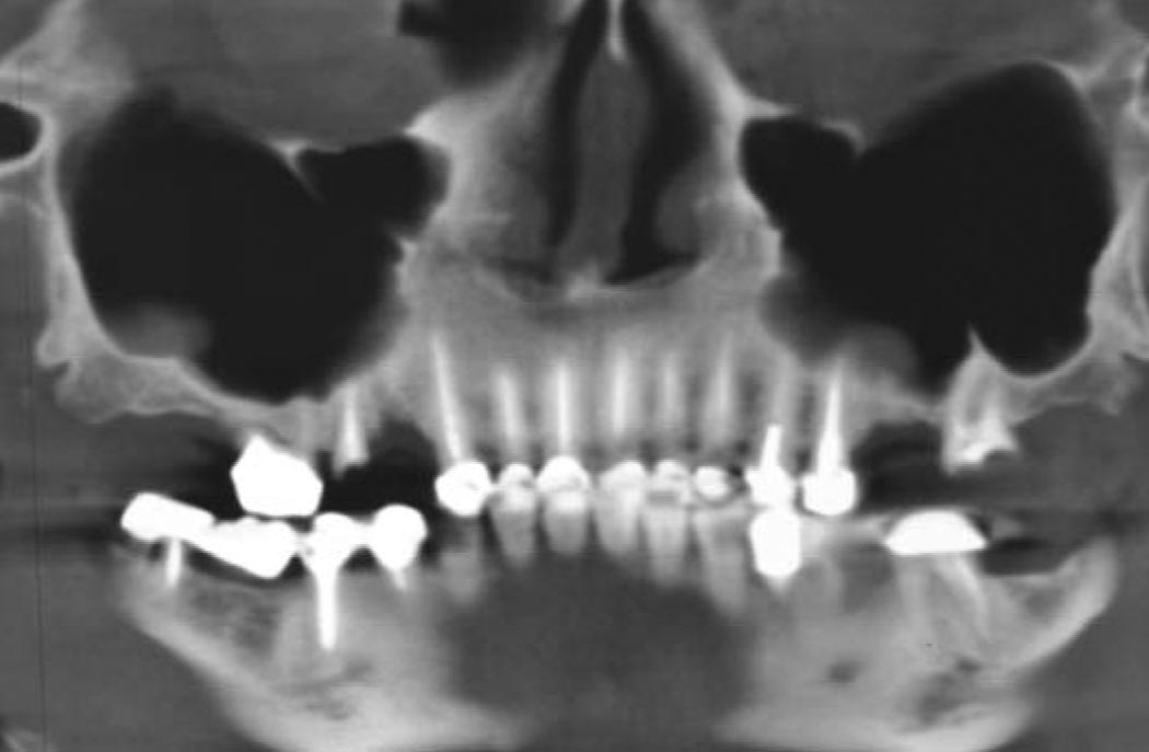 Implant dentaire 06 cannes