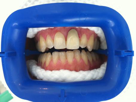 dentiste cannes principe blanchiment dentaire
