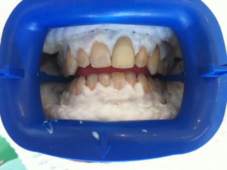 Le Docteur Smadja, dentiste Cannes blanchiment des dents