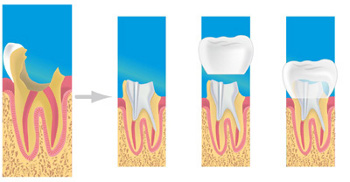 prothèse dentaire cannes